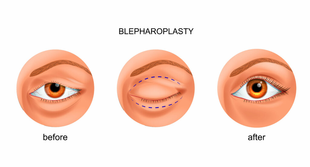 بلفاروپلاستی و درمان افتادگی پلکبلفاروپلاستی و درمان افتادگی پلک